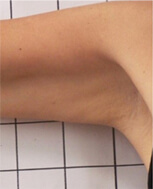 After our Arm Contouring