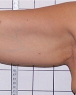 Before our Arm Contouring