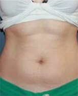 After our Body Contouring
